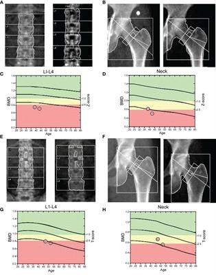 NTCP Deficiency Affects the Levels of Circulating Bile Acids and Induces Osteoporosis